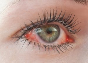 red irritated blepharitis dry eye