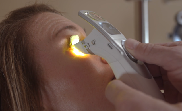 iLux2 dry eye treatment in Costa Mesa
